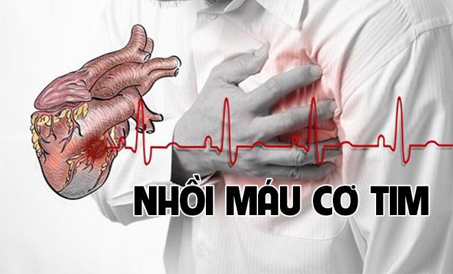 Hướng dẫn xử trí, sơ cứu cho người bị nhồi máu cơ tim | Vinmec