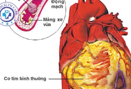  Hướng dẫn sơ cứu nhồi máu cơ tim và những điều lưu ý