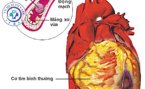  Hướng dẫn sơ cứu nhồi máu cơ tim và những điều lưu ý